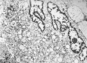 F,68y. | xanthomatous cell in atherosclerotic plaque - a. vertebralis